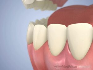 歯周病治療の内容