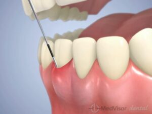 歯周病治療の内容